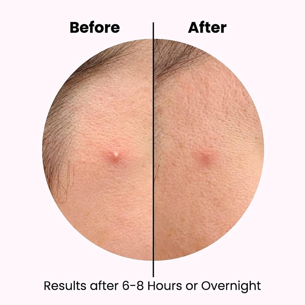 Hydrocolloid Acne Pimples Patches for Face 48 Patches (2 sizes 10mm 12mm) - Picture 6 of 6